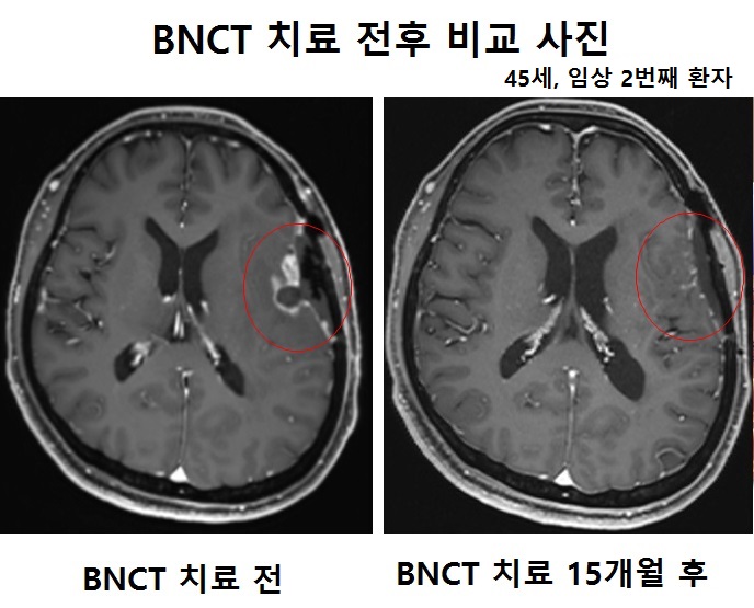 국내 최초 A-BNCT(붕소중성자치료기) 개발